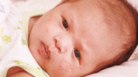 8 first-line treatments for atopic dermatitis in infants
